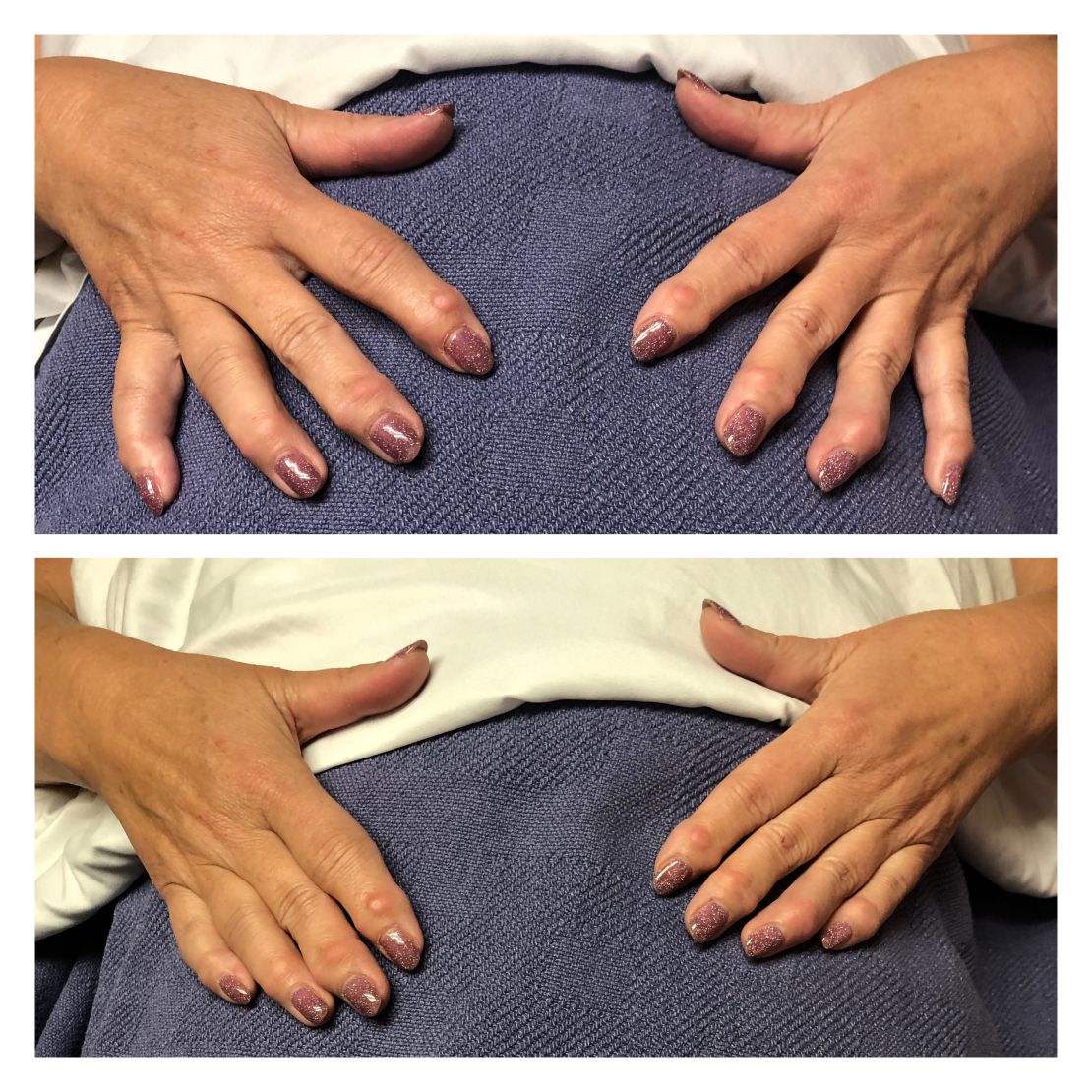 90 minute before and after Manual Lymphatic Drainage arms and Hands